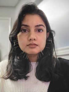 brown-skinned woman with black shoulder-length hair (Dr. Anne) with numerous needles in the face.