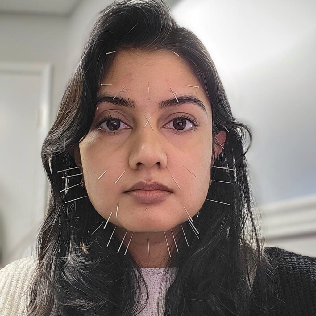 brown-skinned woman with black shoulder-length hair (Dr. Anne) with numerous needles in the face.